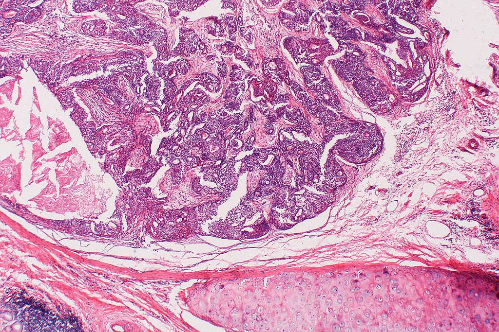 Typical Carcinoid Tumor 5020216730